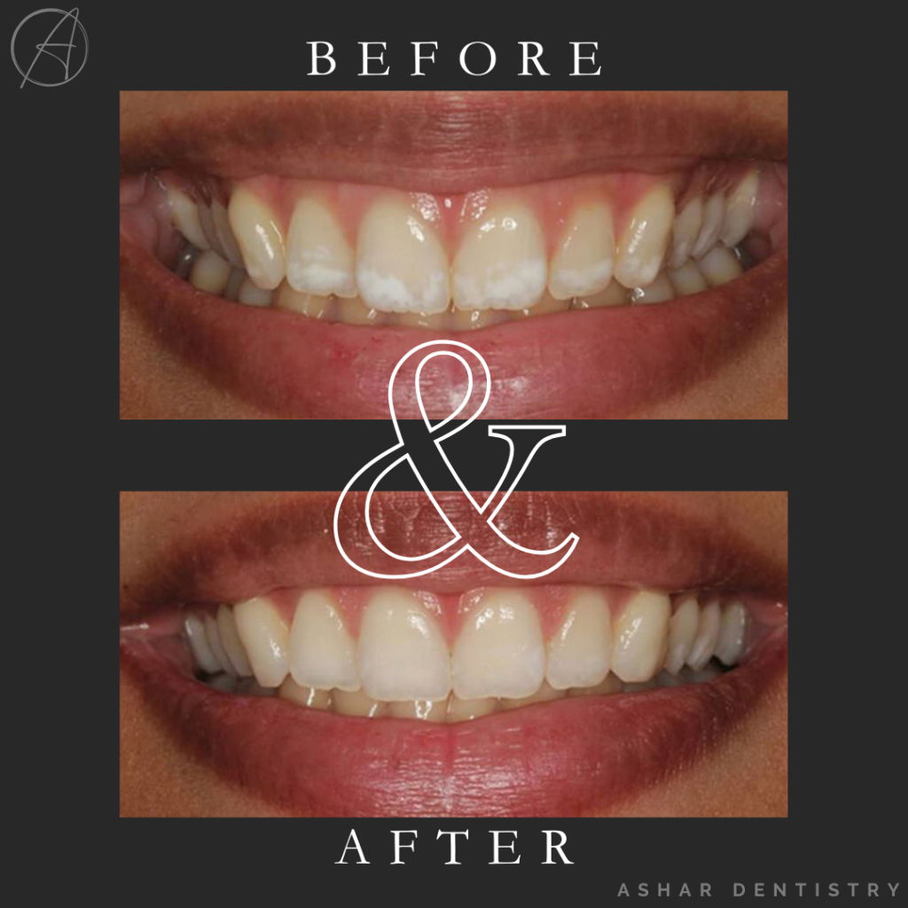 Before and after images of a smile transformation showcasing enhanced teeth appearance with natural-looking veneers, featuring improved tooth color and alignment, associated with Ashar Dentistry's cosmetic dentistry services.