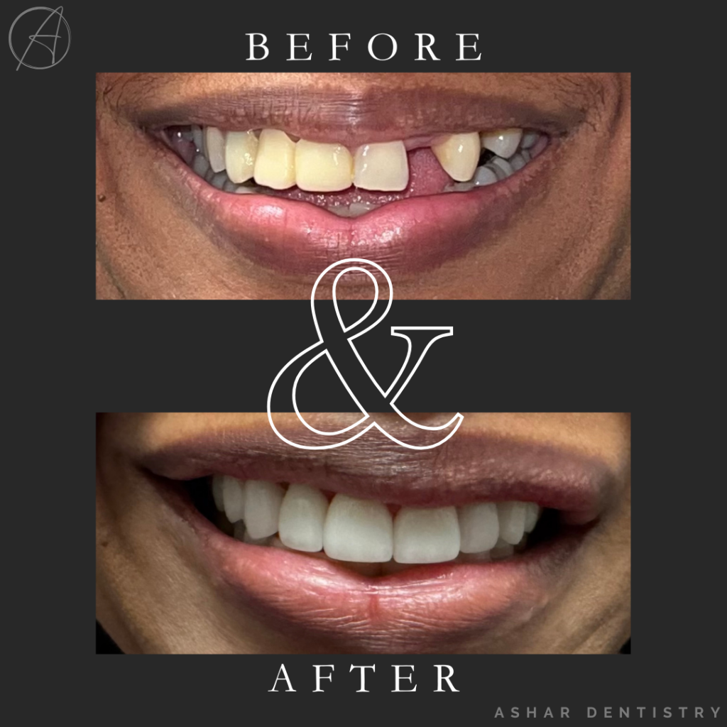 Before and after images of a smile transformation showcasing improved tooth alignment and color, highlighting the results of cosmetic dental procedures at Ashar Dentistry.
