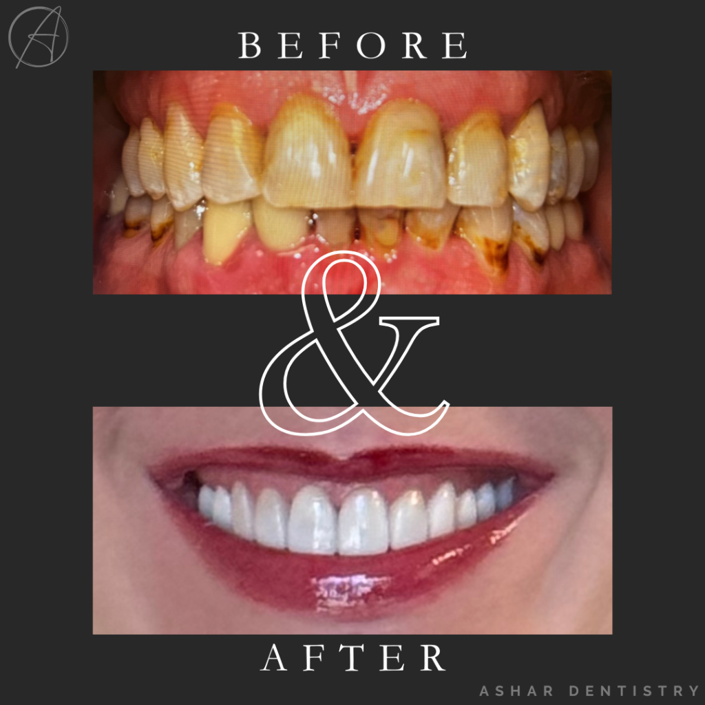 Before and after images of a smile transformation showcasing significant dental improvement with cosmetic veneers, highlighting enhanced tooth color and alignment, branded with Ashar Dentistry logo.