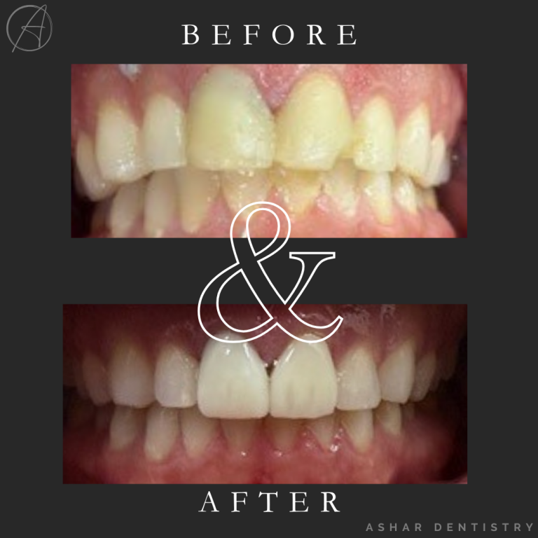 Veneers B&A