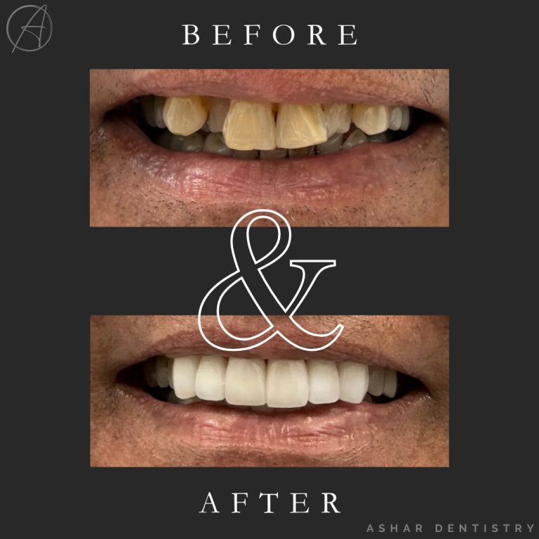 Black and White Lash Tech Before and After Instagram Post (3)